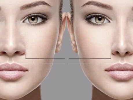 Veja como reduzir a abertura das narinas com a cirurgia no nariz