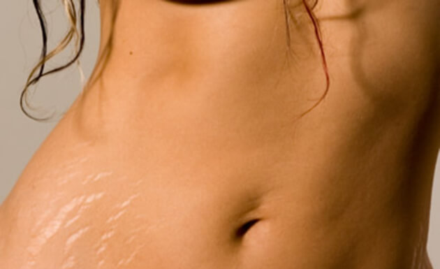 Saiba como prevenir as estrias com o Laser para estrias