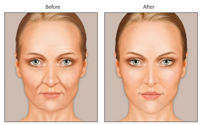 Enxerto de gordura na parte do rosto