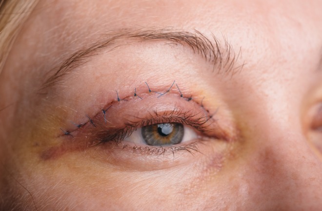 mulher após realização de blefaroplastia