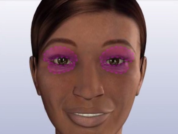 região onde é aplicada a blerafoplastia