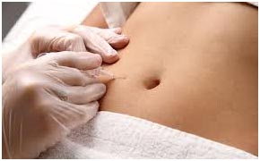 carboxiterapia para tratamento contra celulite