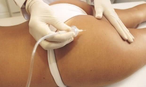 Carboxiterapia para estrias