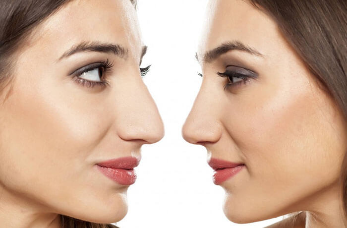 Transformar sua vida por meio da cirurgia no nariz 