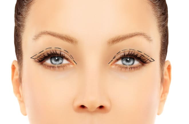 mulher pós cirurgia de blefaroplastia