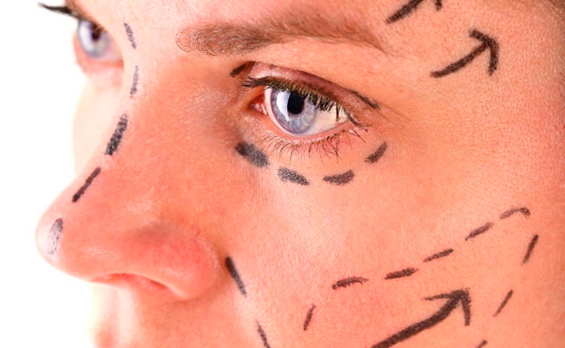 Facelift, conhecida também como lifting facial ou ritidoplastia. olhos e nariz de uma mulher com as marcações antes de uma facelift