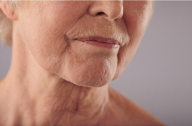 conheça opções de procedimentos estéticos e tratamentos para a flacidez facial mulher com flacidez facial aparente