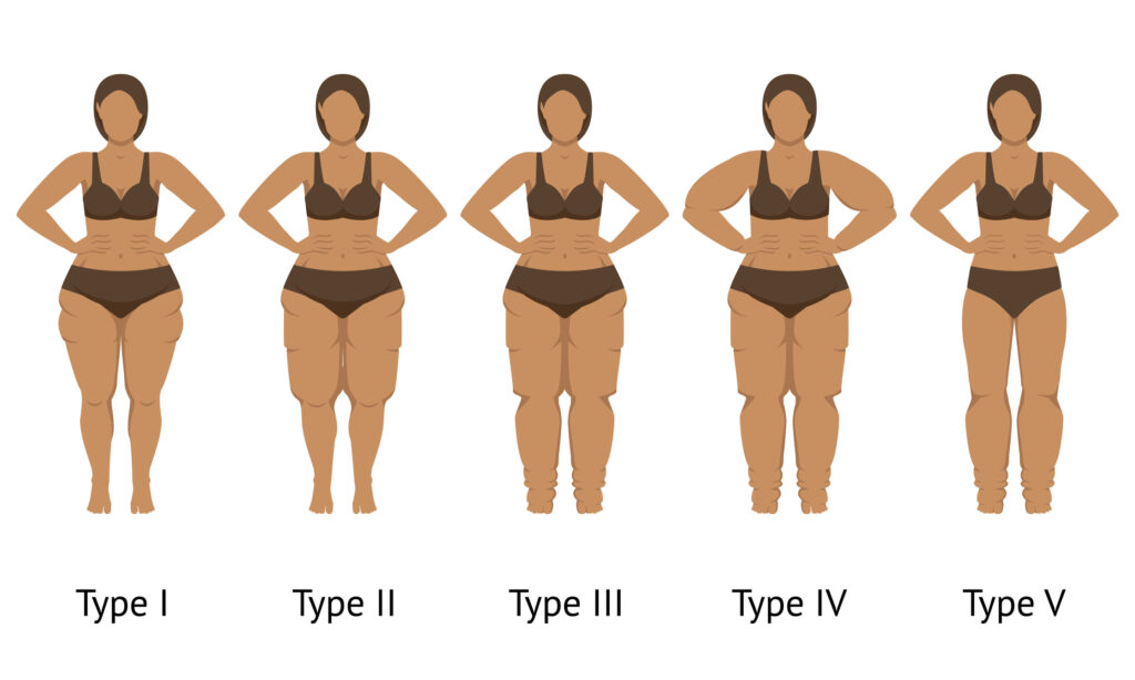 Lipedema