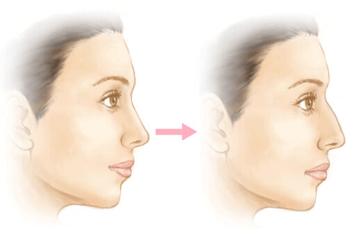 Siferença e transformação da Rinoplastia