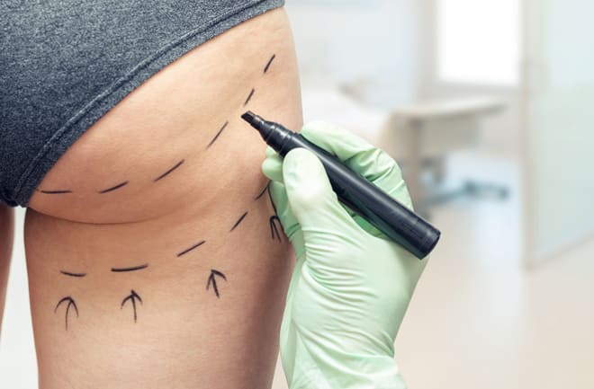 Lipo lad pode ser feita em quais áreas do corpo?