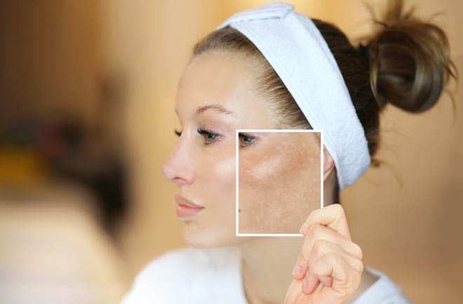mulher com melasma