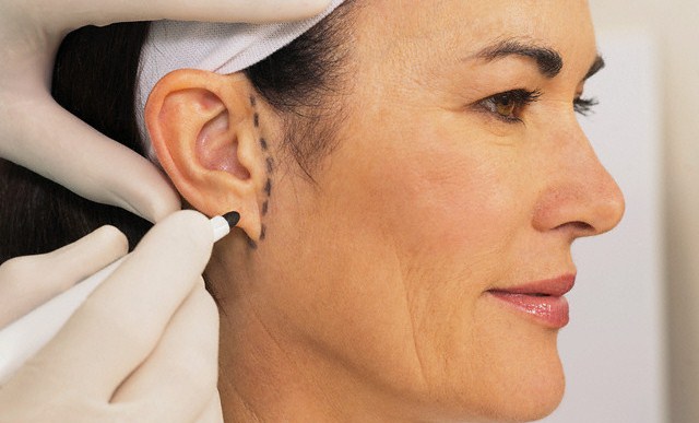 Mulher marcando a orelha antes da otoplastia.
