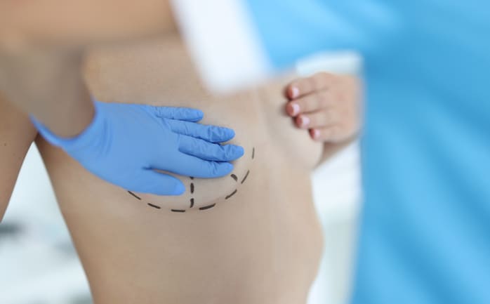 mulher realizando cirurgia de explante mamário