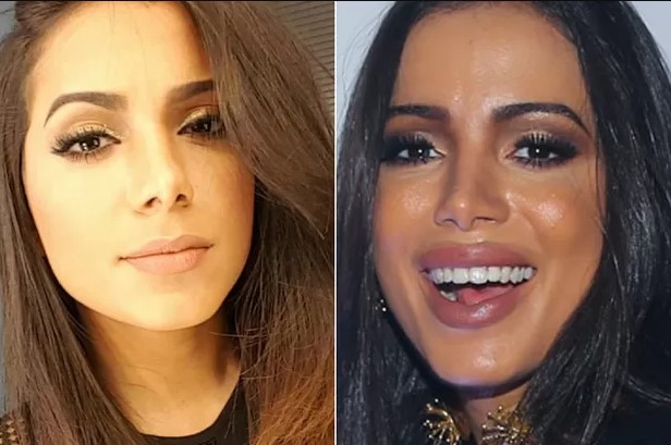 procedimentos-esteticos-anitta