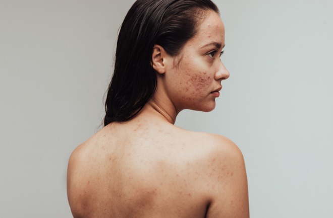 conheça algumas opções de procedimentos estéticos apra amenizar as marcas de acne. mulher candidata a procedimentos para acne com marcas pelo rosto