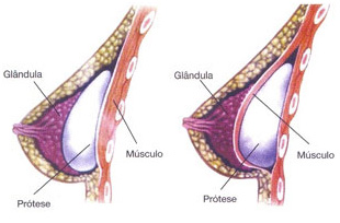 Como fica o silicone nos seios depois da cirurgia?