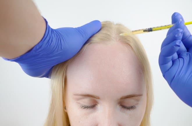 mulher realizando transplante capilar