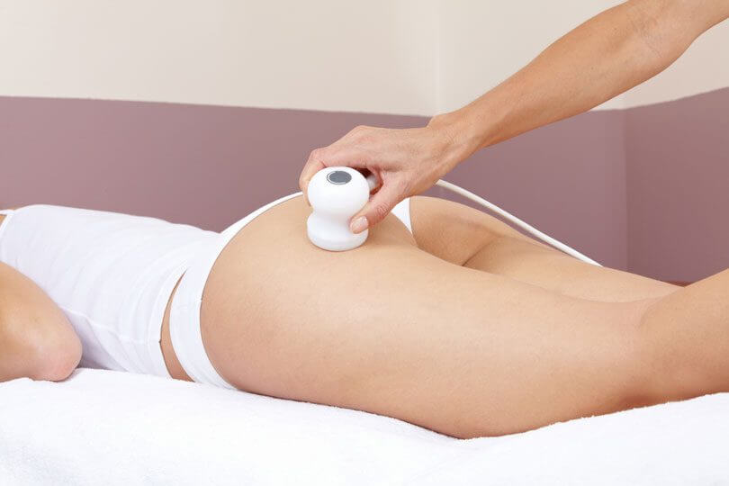 Procedimento A Laser Para Estrias