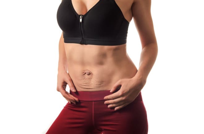 mulher com diástase abdominal